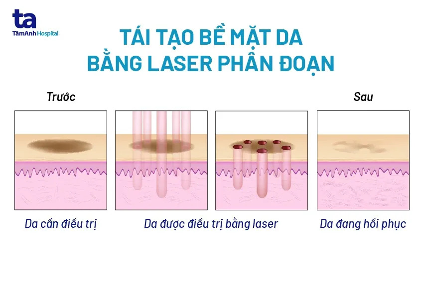 Quy trình điều trị bằng Laser CO2 Fractional